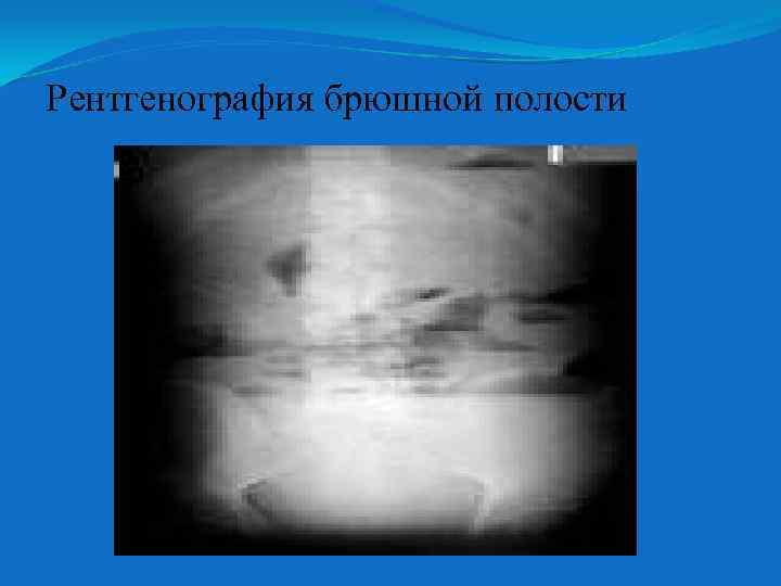 Рентгенография брюшной полости 