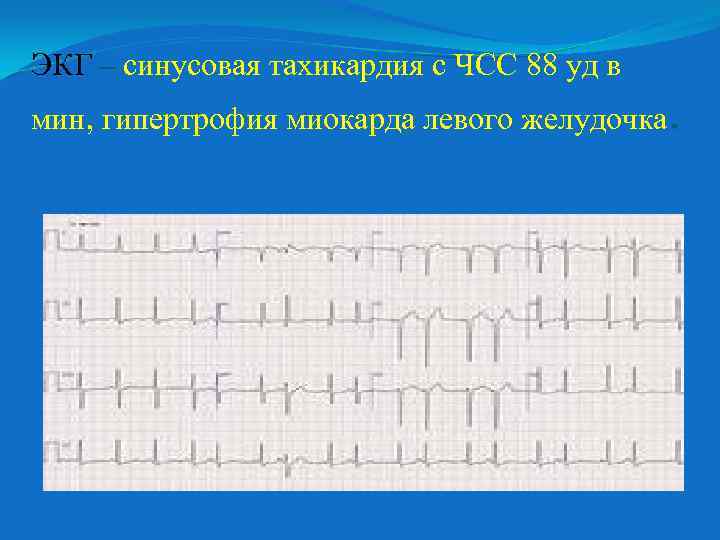 ЭКГ – синусовая тахикардия с ЧСС 88 уд в мин, гипертрофия миокарда левого желудочка.