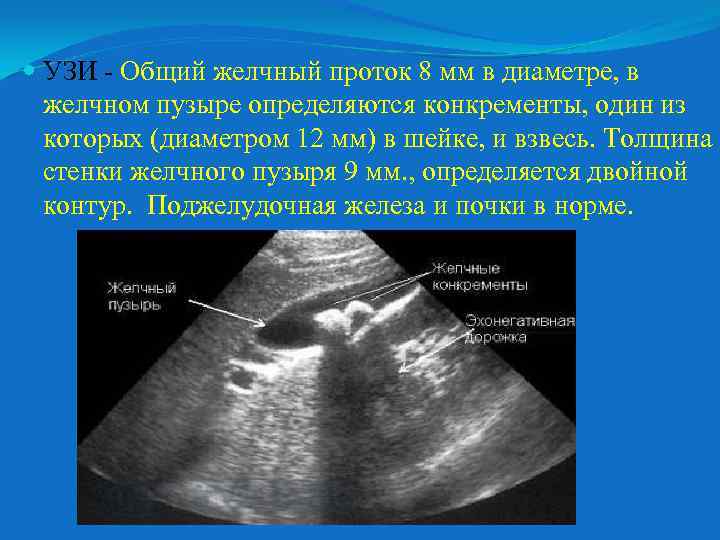  УЗИ - Общий желчный проток 8 мм в диаметре, в желчном пузыре определяются