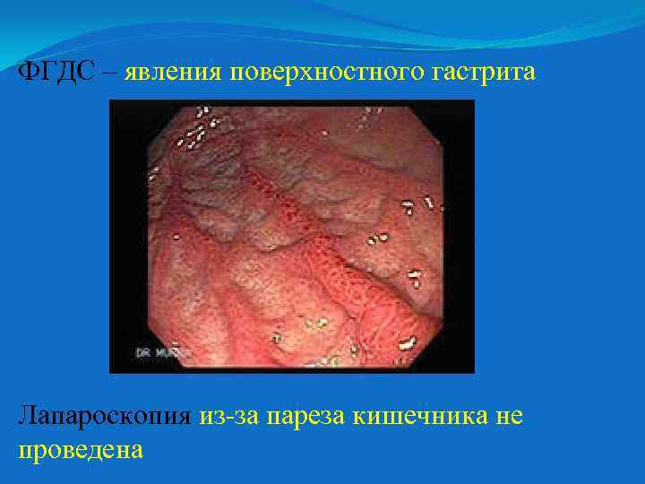 ФГДС – явления поверхностного гастрита Лапароскопия из-за пареза кишечника не проведена 