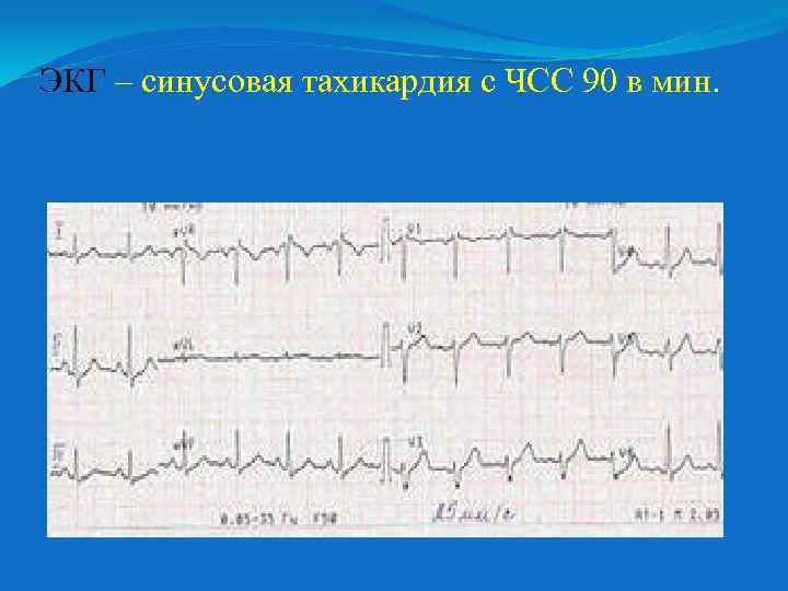 ЭКГ – синусовая тахикардия с ЧСС 90 в мин. 