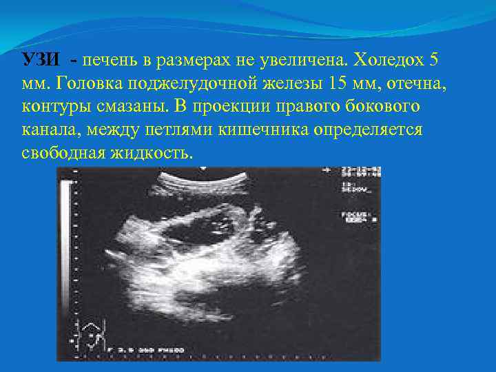 УЗИ - печень в размерах не увеличена. Холедох 5 мм. Головка поджелудочной железы 15