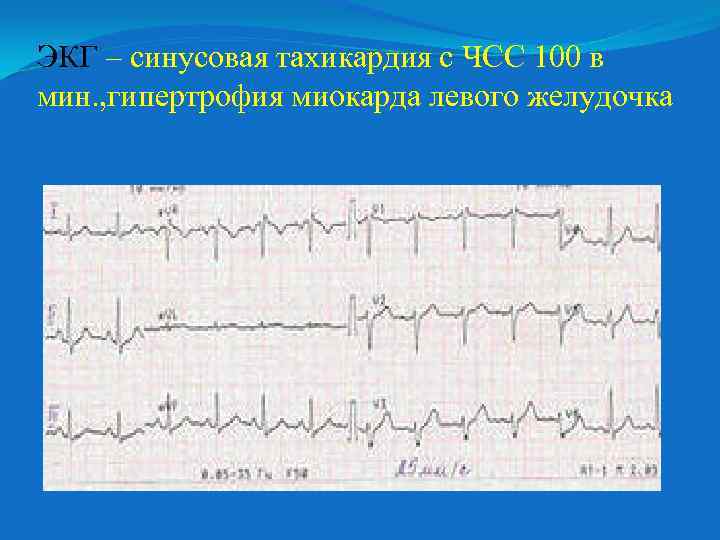 ЭКГ – синусовая тахикардия с ЧСС 100 в мин. , гипертрофия миокарда левого желудочка