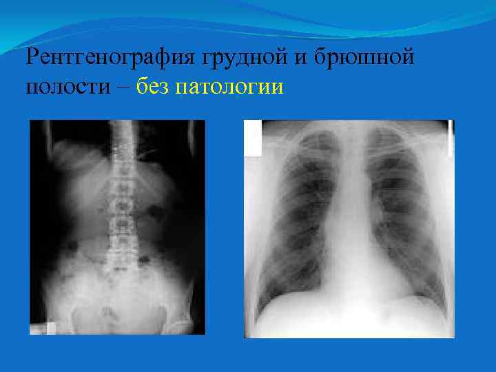 Рентгенография грудной и брюшной полости – без патологии 