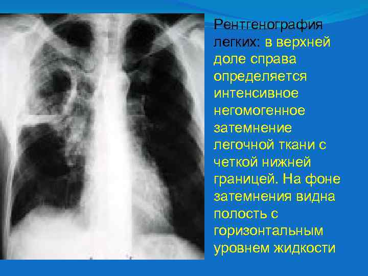 Рентгенография легких: в верхней доле справа определяется интенсивное негомогенное затемнение легочной ткани с четкой