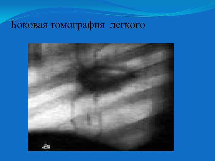 Боковая томография легкого 