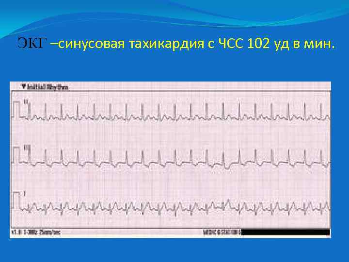 ЭКГ –синусовая тахикардия с ЧСС 102 уд в мин. 
