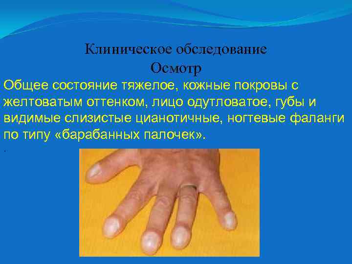 Клиническое обследование Осмотр Общее состояние тяжелое, кожные покровы с желтоватым оттенком, лицо одутловатое, губы