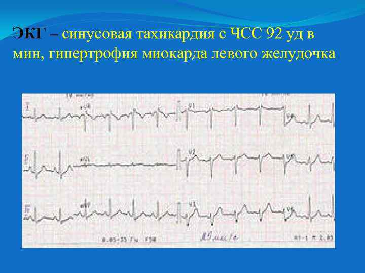 ЭКГ – синусовая тахикардия с ЧСС 92 уд в мин, гипертрофия миокарда левого желудочка.