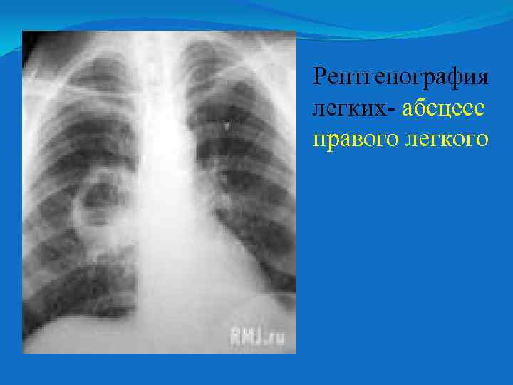 Рентгенография легких- абсцесс правого легкого 