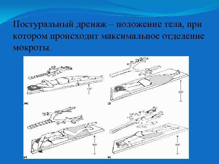 Постуральный дренаж – положение тела, при котором происходит максимальное отделение мокроты. 