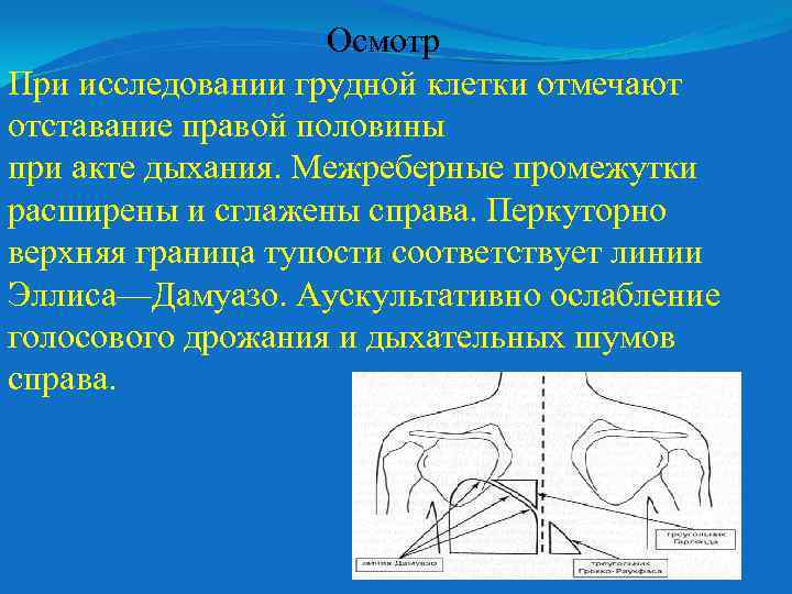 Осмотр При исследовании грудной клетки отмечают отставание правой половины при акте дыхания. Межреберные промежутки