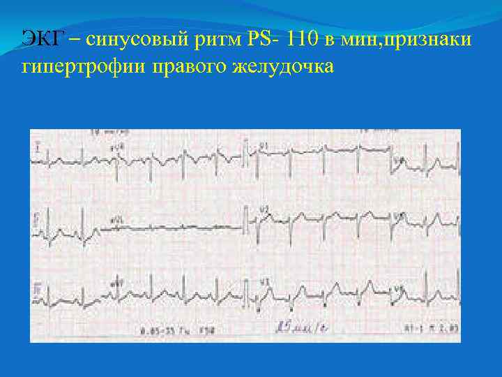 ЭКГ – синусовый ритм PS- 110 в мин, признаки гипертрофии правого желудочка 