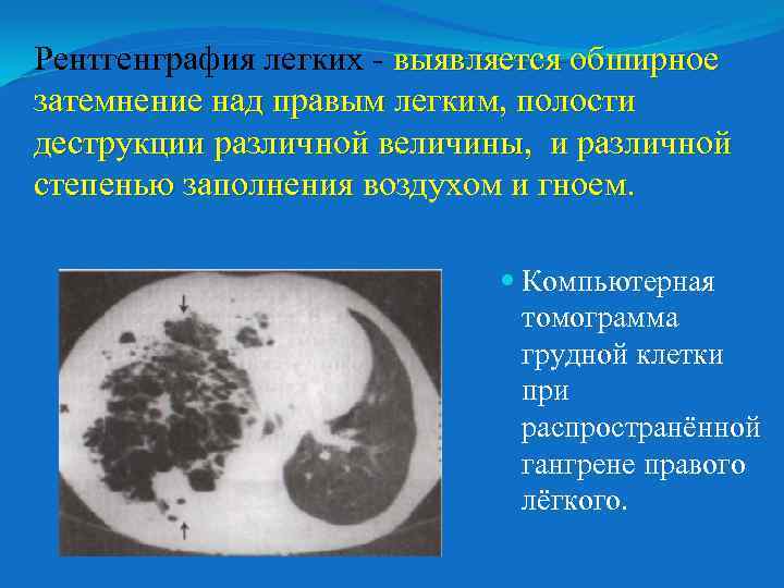 Рентгенграфия легких - выявляется обширное затемнение над правым легким, полости деструкции различной величины, и