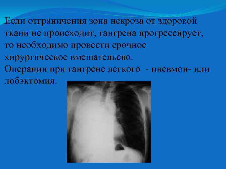 Если отграничения зона некроза от здоровой ткани не происходит, гангрена прогрессирует, то необходимо провести