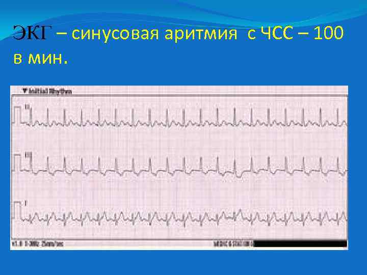 ЭКГ – синусовая аритмия с ЧСС – 100 в мин. 