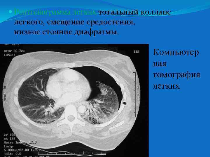  Рентгенограмма легких тотальный коллапс легкого, смещение средостения, низкое стояние диафрагмы. Компьютер ная томография