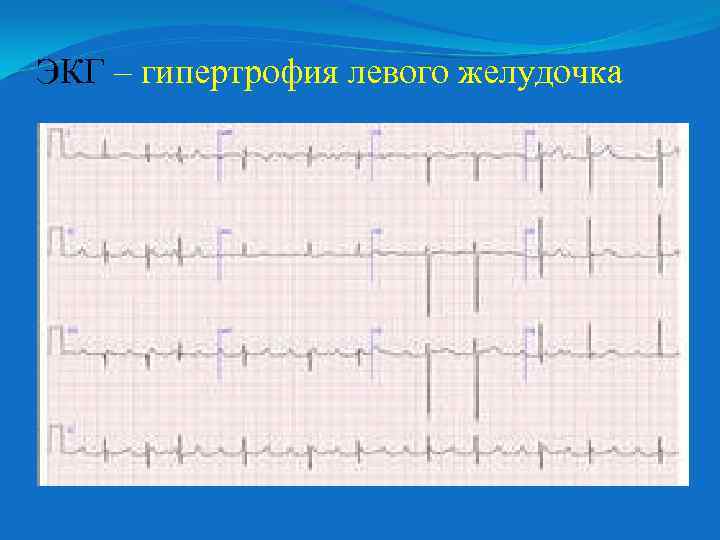 ЭКГ – гипертрофия левого желудочка 