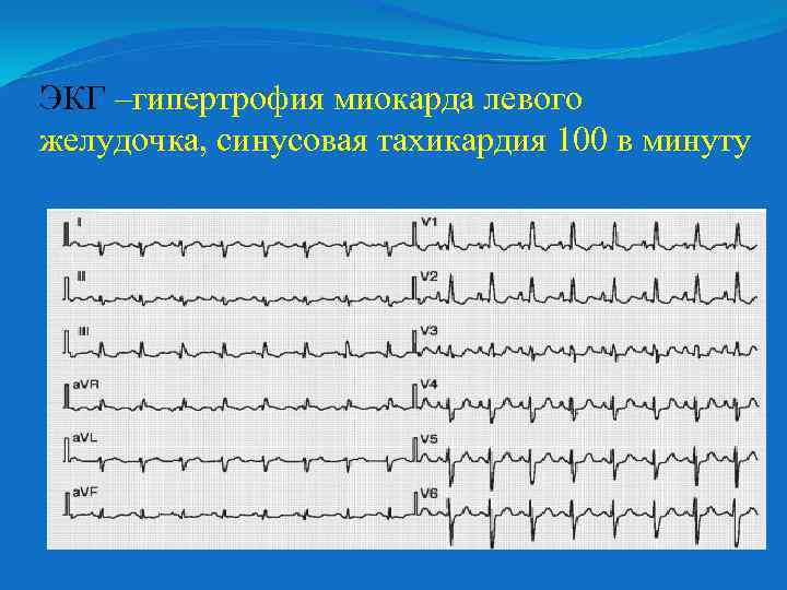 ЭКГ –гипертрофия миокарда левого желудочка, синусовая тахикардия 100 в минуту 