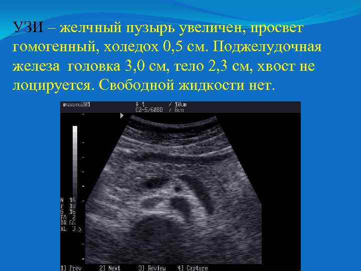УЗИ – желчный пузырь увеличен, просвет гомогенный, холедох 0, 5 см. Поджелудочная железа головка