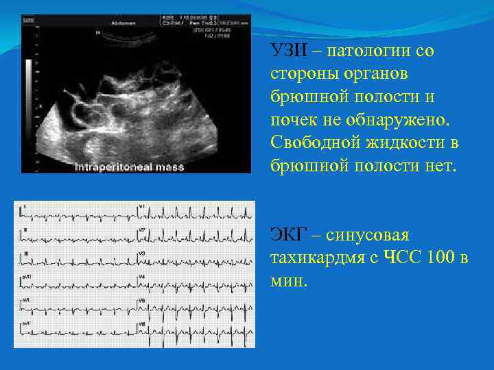 УЗИ – патологии со стороны органов брюшной полости и почек не обнаружено. Свободной жидкости