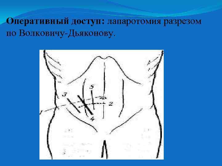 Оперативный доступ: лапаротомия разрезом по Волковичу-Дьяконову. 