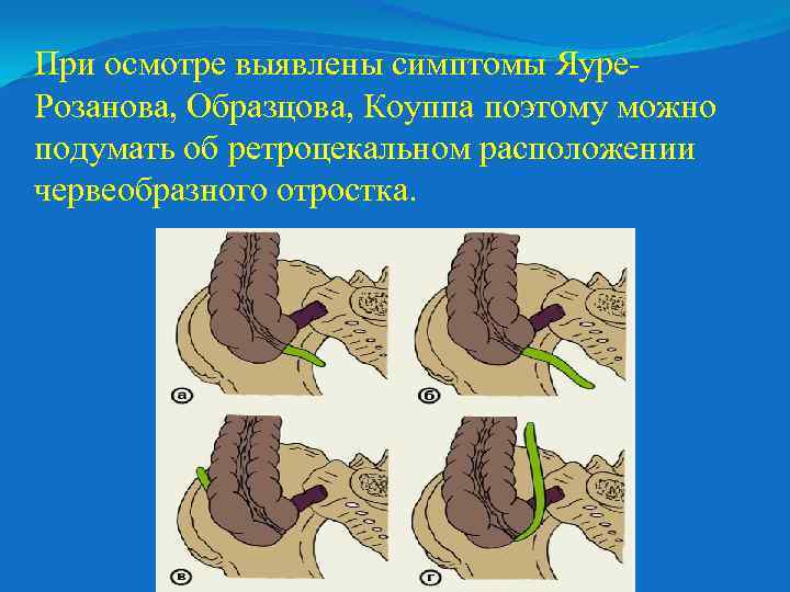 При осмотре выявлены симптомы Яуре. Розанова, Образцова, Коуппа поэтому можно подумать об ретроцекальном расположении