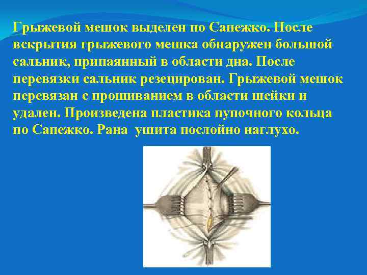 Грыжевой мешок выделен по Сапежко. После вскрытия грыжевого мешка обнаружен большой сальник, припаянный в