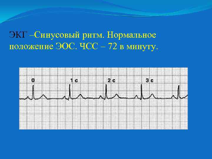 ЭКГ –Синусовый ритм. Нормальное положение ЭОС. ЧСС – 72 в минуту. 