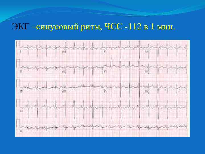 ЭКГ –синусовый ритм, ЧСС -112 в 1 мин. 