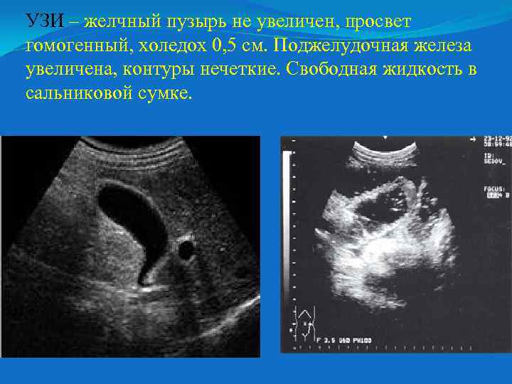 УЗИ – желчный пузырь не увеличен, просвет гомогенный, холедох 0, 5 см. Поджелудочная железа