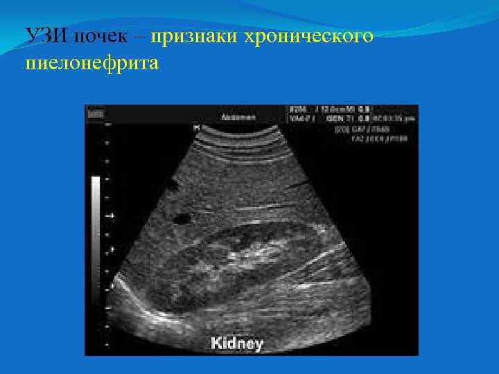 УЗИ почек – признаки хронического пиелонефрита 