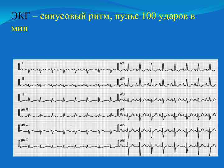 ЭКГ – синусовый ритм, пульс 100 ударов в мин 