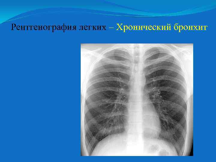 Рентгенография легких – Хронический бронхит 