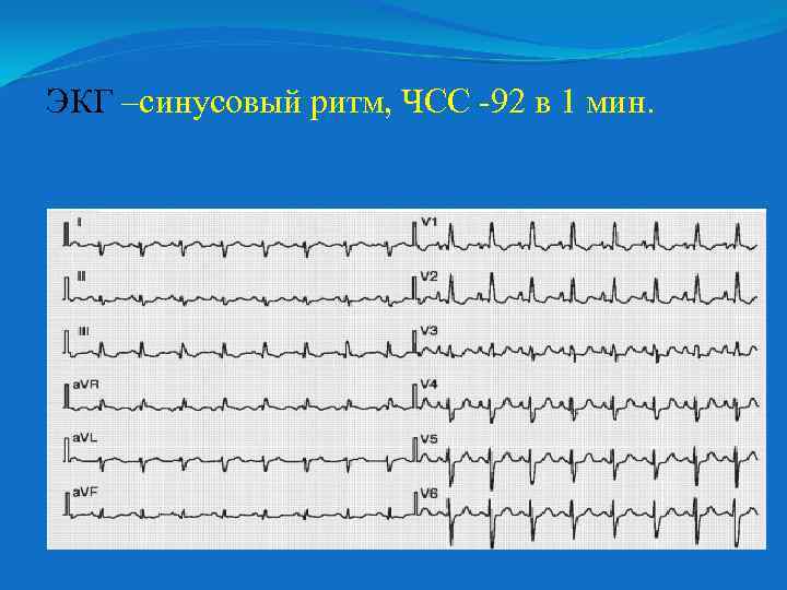 ЭКГ –синусовый ритм, ЧСС -92 в 1 мин. 