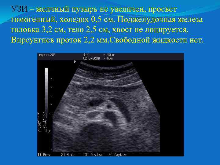 УЗИ – желчный пузырь не увеличен, просвет гомогенный, холедох 0, 5 см. Поджелудочная железа