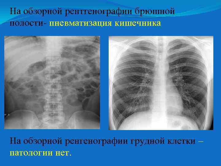 На обзорной рентгенографии брюшной полости- пневматизация кишечника На обзорной ренгенографии грудной клетки – патологии