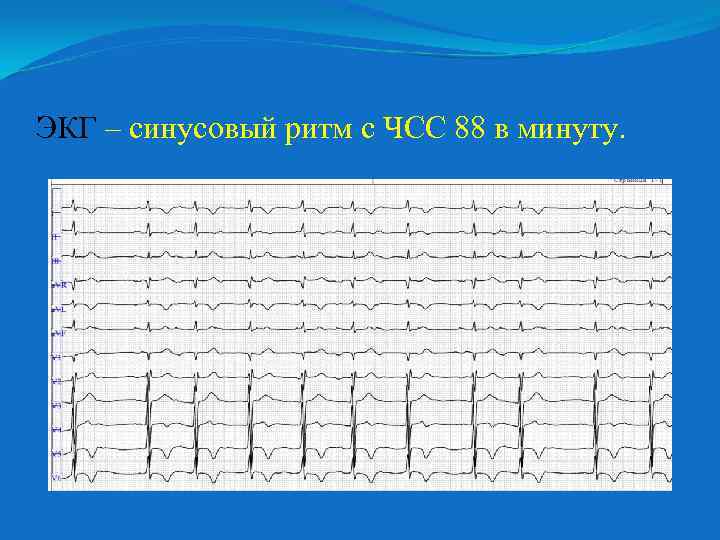 ЭКГ – синусовый ритм с ЧСС 88 в минуту. 