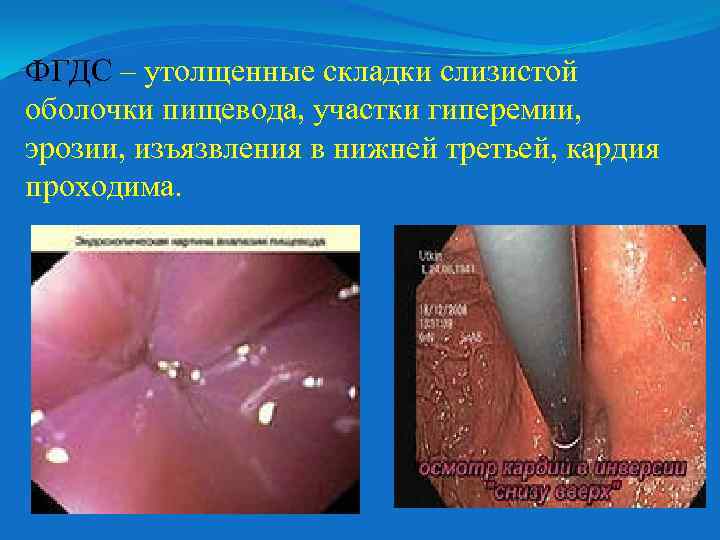 ФГДС – утолщенные складки слизистой оболочки пищевода, участки гиперемии, эрозии, изъязвления в нижней третьей,