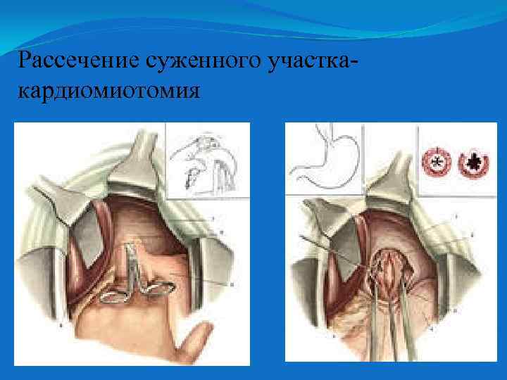 Рассечение суженного участкакардиомиотомия 