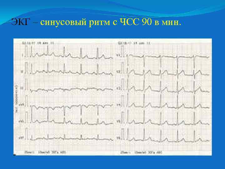 ЭКГ – синусовый ритм с ЧСС 90 в мин. 