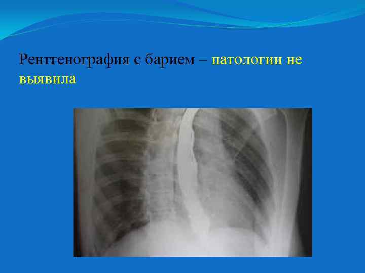 Рентгенография с барием – патологии не выявила 
