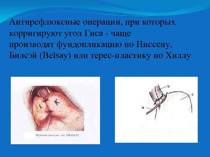 Антирефлюксные операции, при которых корригируют угол Гиса - чаще производят фундопликацию по Ниссену, Билсэй