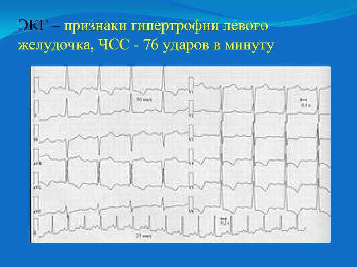 ЭКГ – признаки гипертрофии левого желудочка, ЧСС - 76 ударов в минуту 