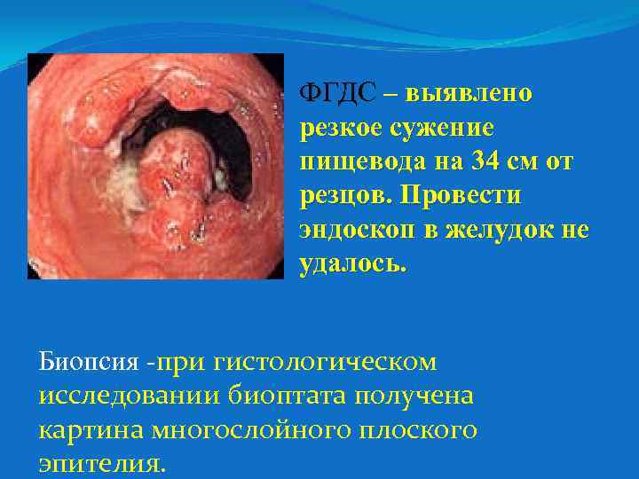 ФГДС – выявлено резкое сужение пищевода на 34 см от резцов. Провести эндоскоп в