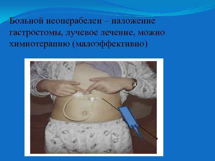 Больной неоперабелен – наложение гастростомы, лучевое лечение, можно химиотерапию (малоэффективно) 