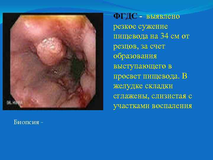 ФГДС - выявлено резкое сужение пищевода на 34 см от резцов, за счет образования