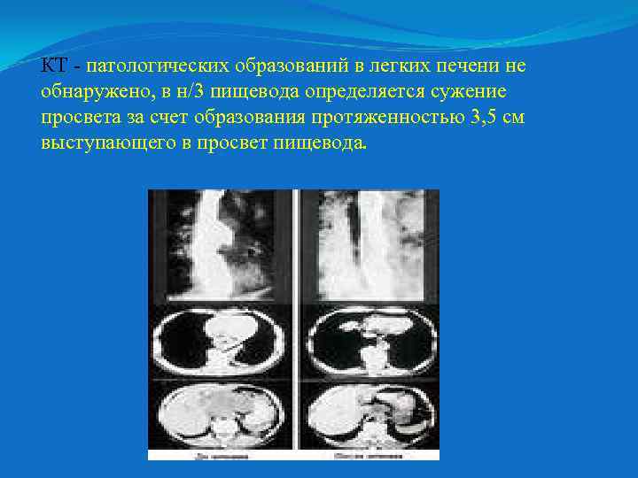 КТ - патологических образований в легких печени не обнаружено, в н/3 пищевода определяется сужение