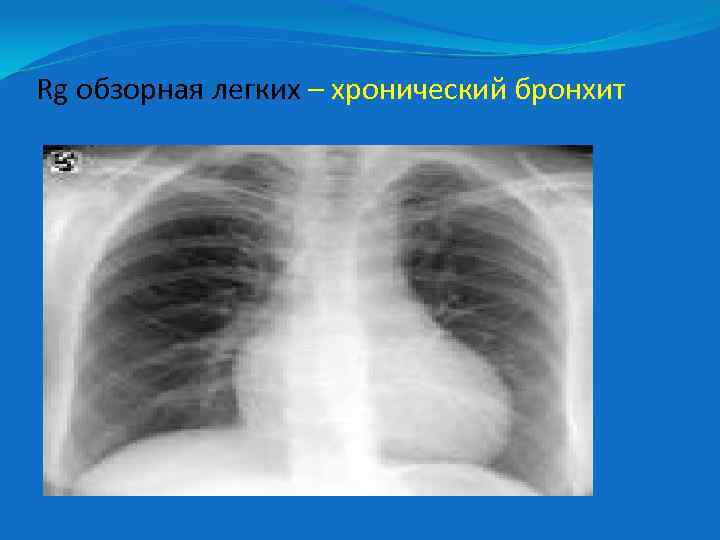 Rg обзорная легких – хронический бронхит 