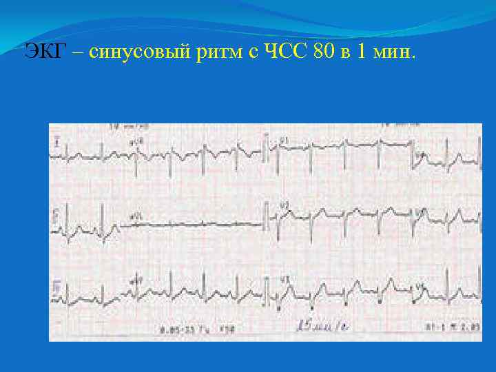 ЭКГ – синусовый ритм с ЧСС 80 в 1 мин. 